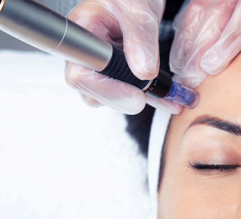 Microneedling